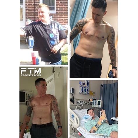 phalloplasty results 2018|Suprapubic phalloplasty in transmen: surgical results and .